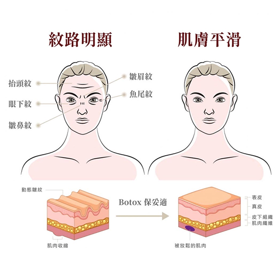 肉毒桿菌注射|淡化抬頭紋|淡化細紋|魚尾紋醫美解決方案 – 杉杏醫美診所 - 杉杏