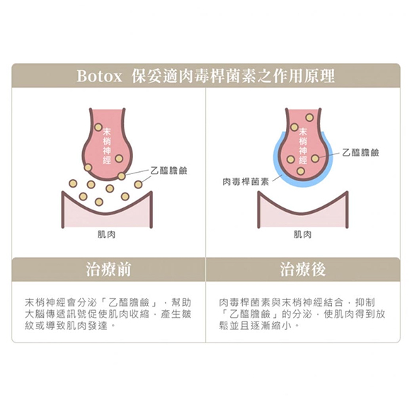 肉毒桿菌注射|淡化抬頭紋|淡化細紋|魚尾紋醫美解決方案 – 杉杏醫美診所 - 杉杏